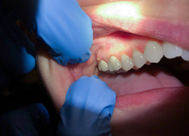 Best Emergency Dentist for Lost Fillings or Crowns in Honaunau Napoopoo, HI